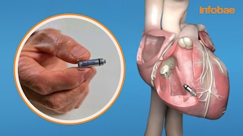 El pequeño dispositivo del tamaño de una cápsula que ya se usa para tratar el corazón en Perú