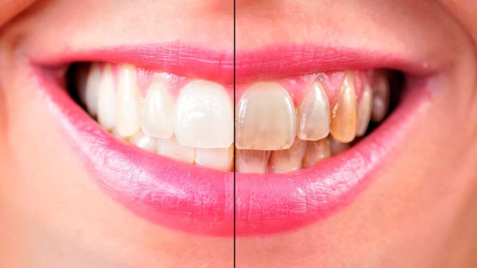 Pasta con queratina obtenida del cabello humano podría ayudar a restaurar el esmalte dental y prevenir daños(Foto: UNAM Global Revista)