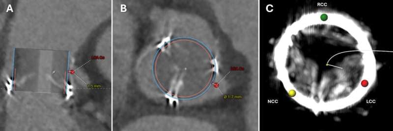 El equipo del NIH y la Universidad de Emory realizó el primer bypass coronario mínimamente invasivo, evitando abrir el tórax del paciente (NIH)