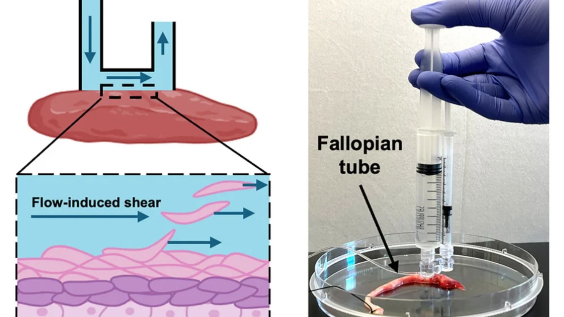 La herramienta aplica tensión de cizallamiento mediante fluidos para desprender células específicas según el tipo de tumor (Gentileza, estudio A fluidic-shear device for minimally disruptive, site-selective collection of viable cells from excised fallopian-tube tissue, publicado en Device.)