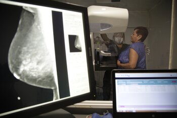 La mastografía detecta cambios o