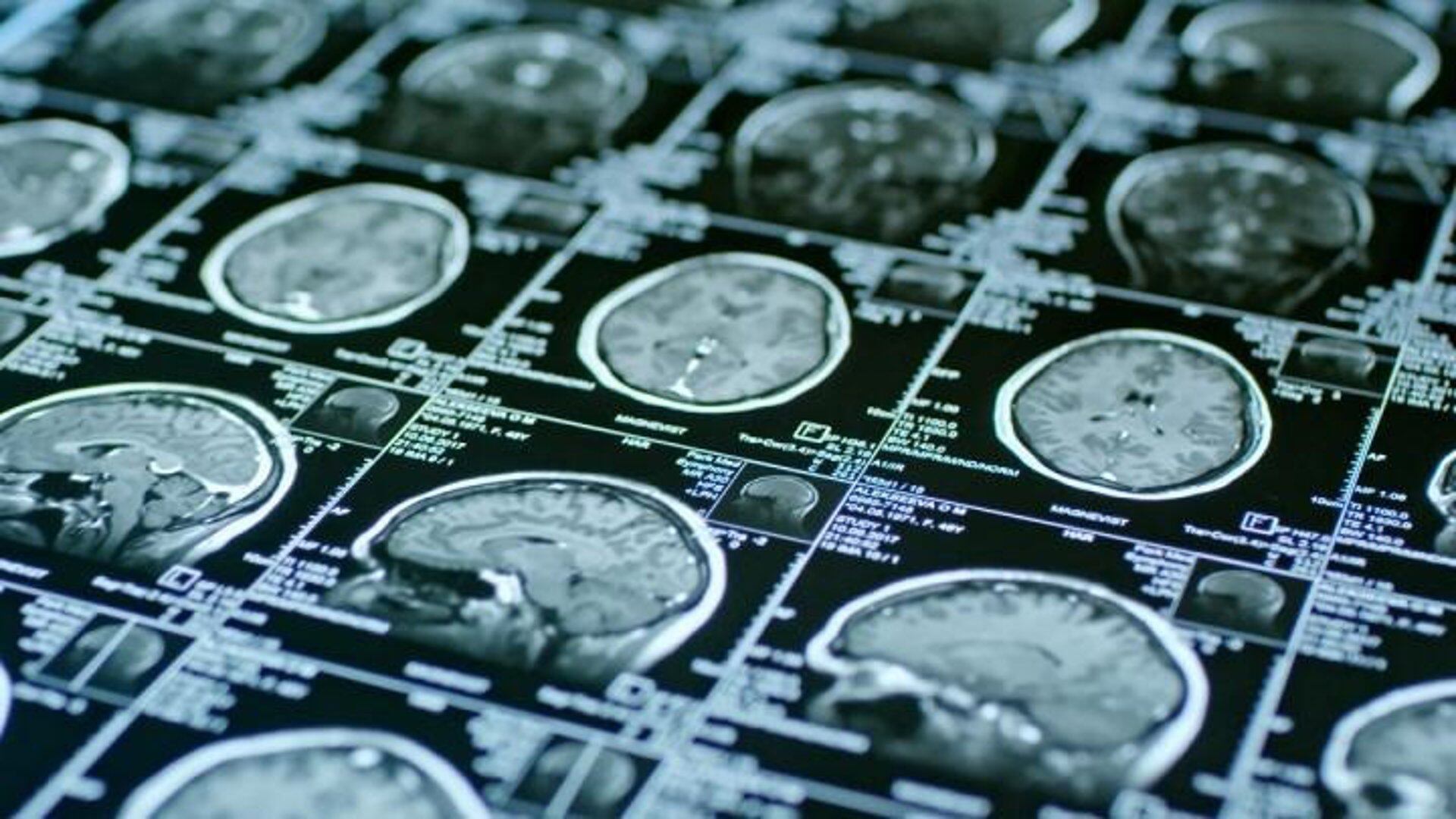 La SEN alerta de que los pacientes esperan una media de 109 días para una consulta de neurología
