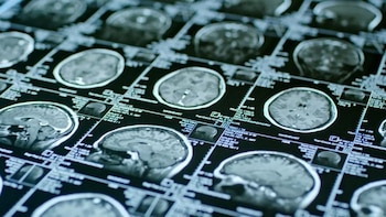 La SEN alerta de que los pacientes esperan una media de 109 días para una consulta de neurología