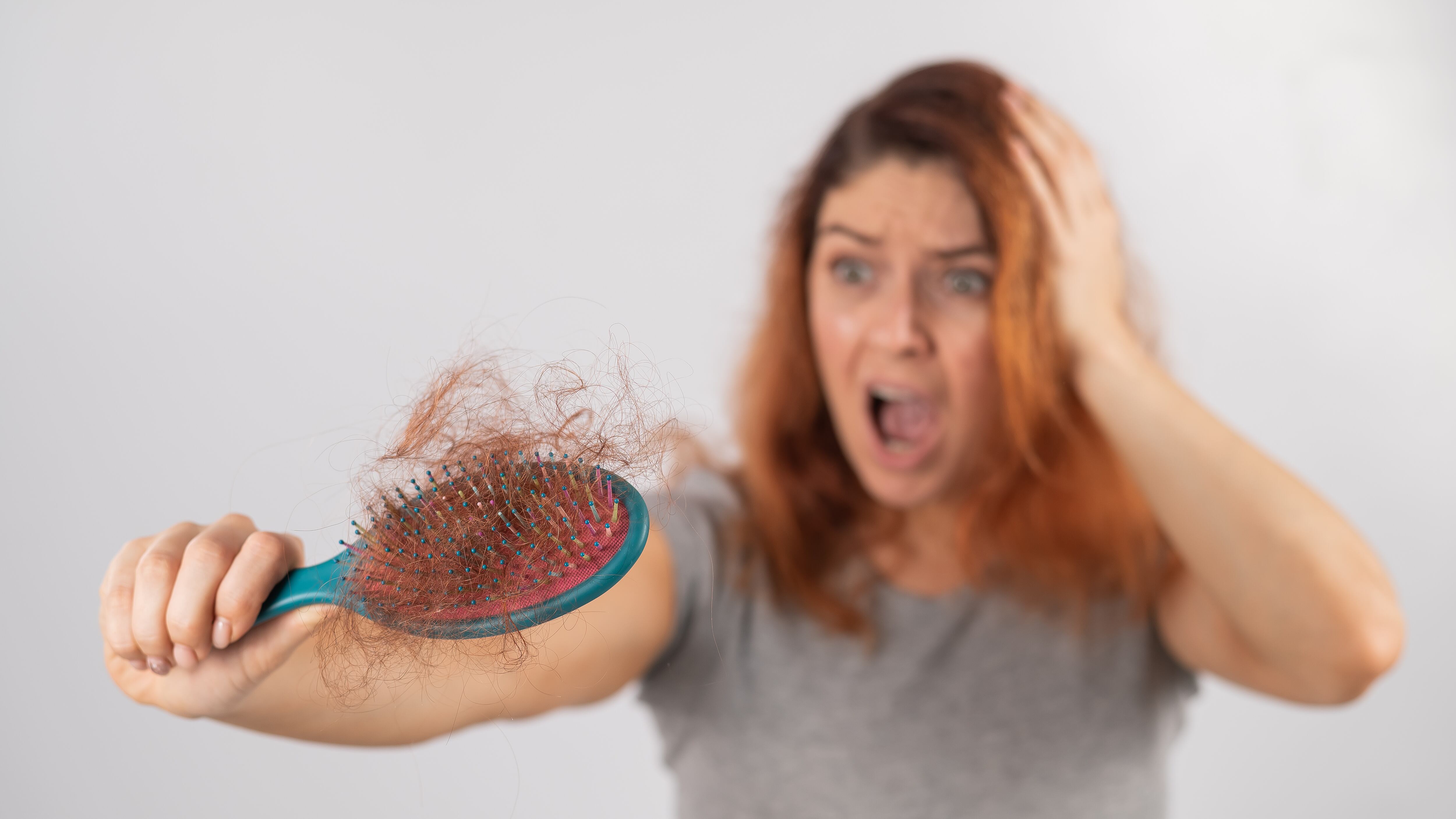 La alopecia androgenética es la forma más común de pérdida capilar y se manifiesta con afinamiento progresivo del cabello en hombres y mujeres (Freepik)