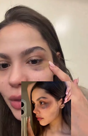 Alejandra Urrea contó cómo terminó con un ojo morado - crédito @alejandraurreaa/tiktok