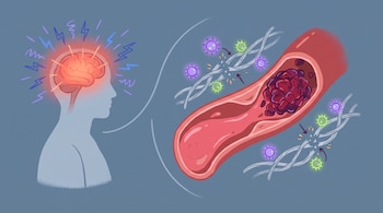 Silueta de persona con cerebro rojo y rayos. Vena y arteria con coágulo, sangre rosada, esferas luminosas violetas y verdes que rompen fibras de fibrina.