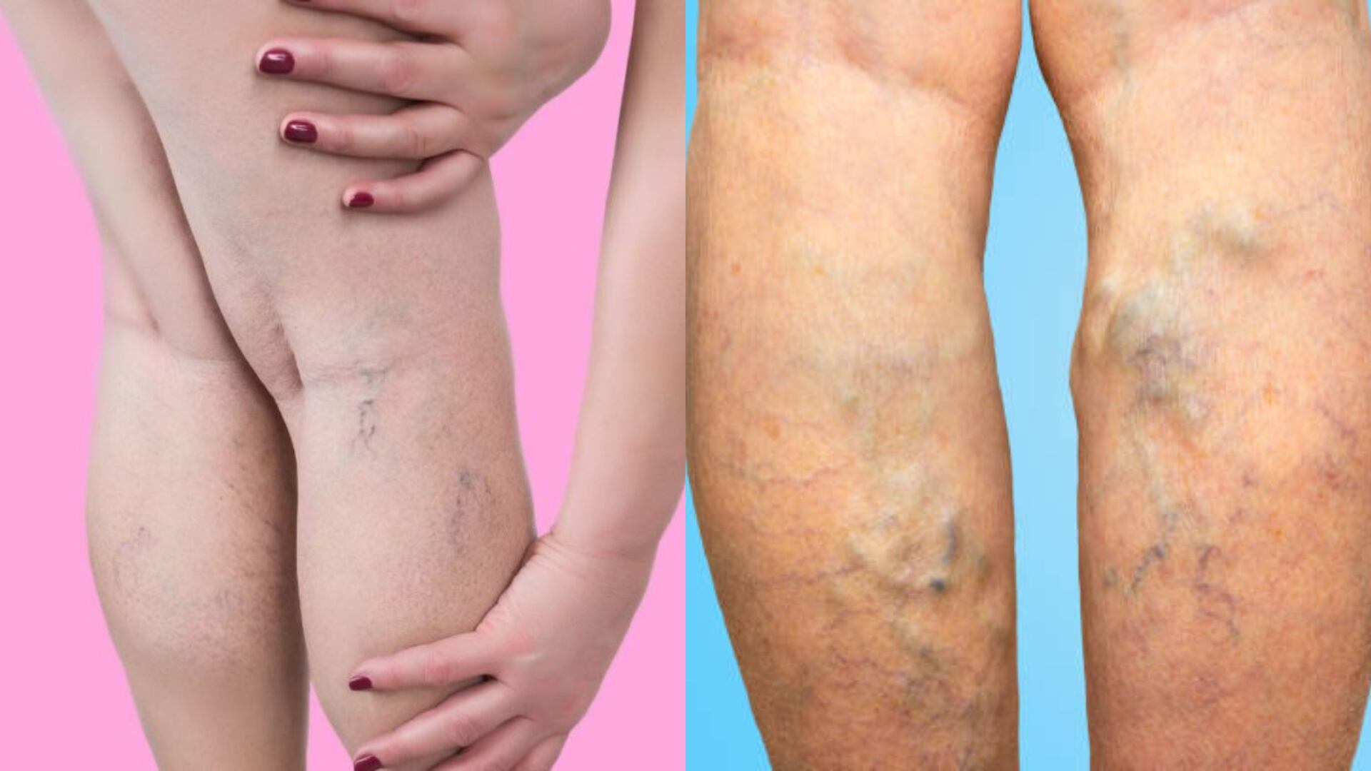 El aceite esencial ideal para eliminar varices, ‘arañitas’ y venas varicosas que es económico y fácil de conseguir (RS)