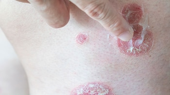 leishmaniasis cutánea 1920