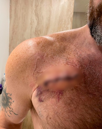 Julián Gil, Cáncer de piel