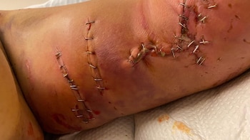 Debido a las violentas heridas