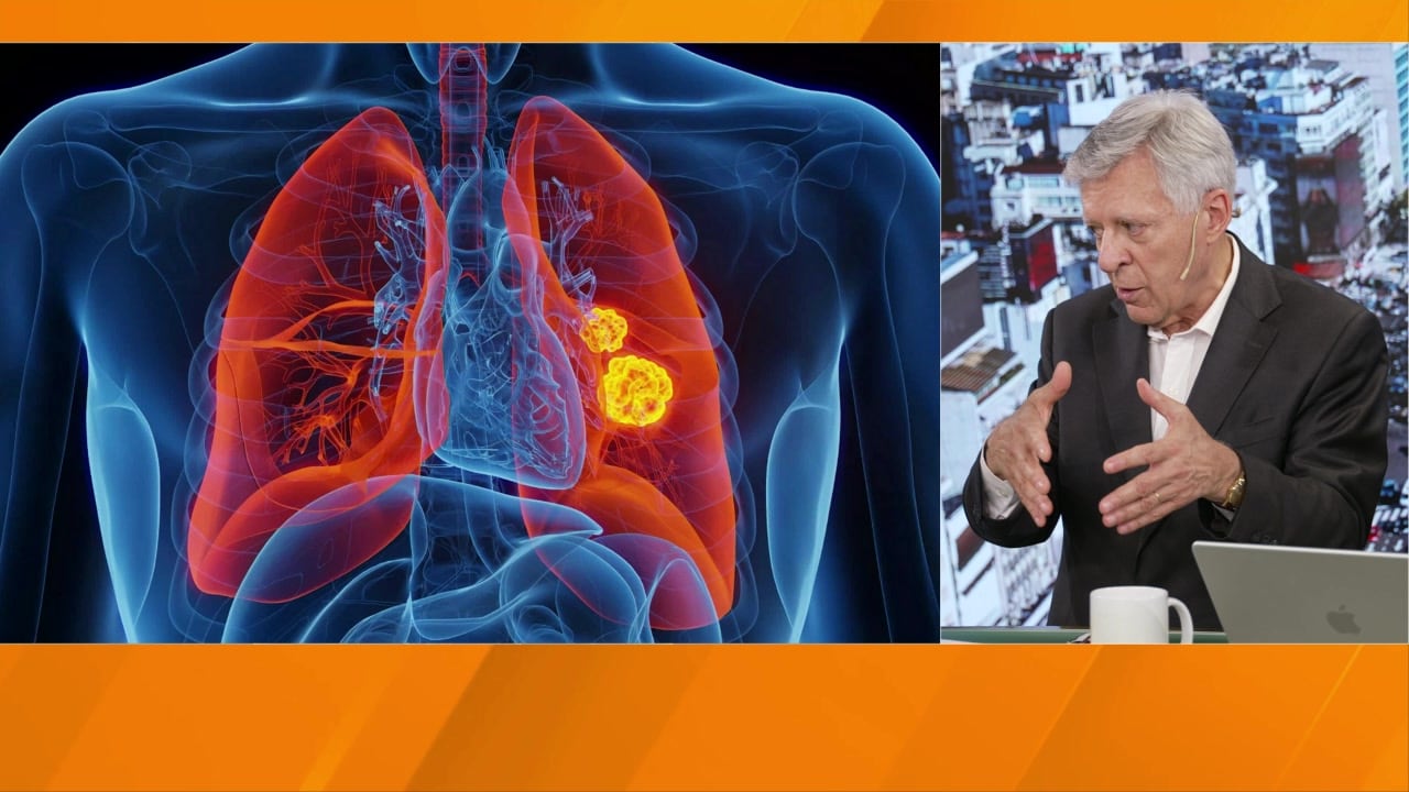 El análisis realizado durante la operación confirmó el diagnóstico de un adenocarcinoma pulmonar. (Imagen Ilustrativa Infobae)