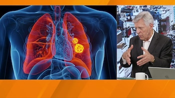 El análisis realizado durante la operación confirmó el diagnóstico de un adenocarcinoma pulmonar. (Imagen Ilustrativa Infobae)
