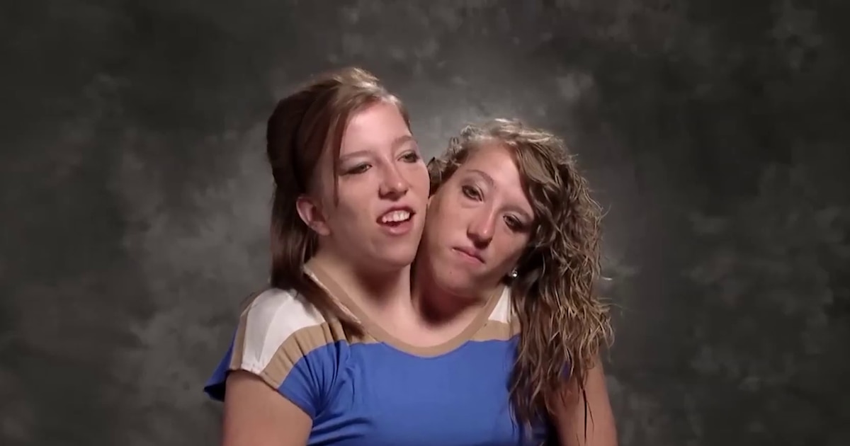La inspiradora vida de las siamesas Abby y Brittany Hensel, una historia que desafía los límites de la medicina y genera una polémica fascinación mundial - Infobae