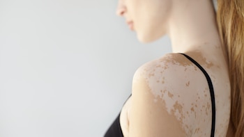 El vitiligo no es igual en todos: un estudio descubrió diferencias genéticas según la edad de inicio