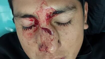 Brutal agresión a un árbitro en Salta: tras sacarle amarilla, le dio un cabezazo en la cara y le fracturó la nariz 