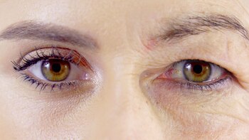 ¿Párpados caídos? Blefaroláser, un tratamiento