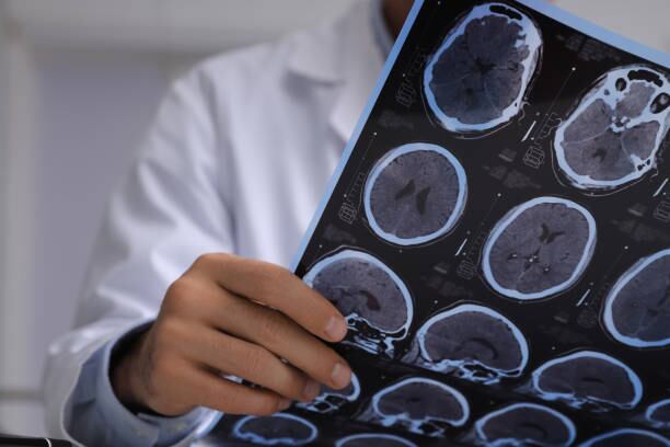 El Alzheimer es una enfermedad que no se puede curar, pero se ha demostrado que ciertos hábitos de vida podrían retrasar su aparición. Foto: (iStock)