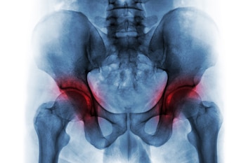 El estudio destaca la importancia de fortalecer músculos específicos del muslo y la tibia, pues esto podría ralentizar el deterioro articular