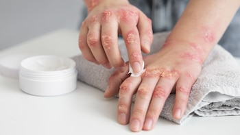 Matico - planta amazónica -planta medicinal - Perú - salud - 7 agosto