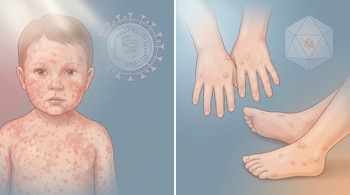 Ilustración médica dividida mostrando dos afecciones virales en niños: a la izquierda, un niño con erupción roja; a la derecha, manos y pies con vesículas.