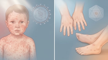 Sarampión y coxsackie: ¿cómo puedes diferenciar los síntomas de ambas enfermedades?