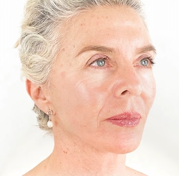 El especialista indicó que el objetivo era preservar una apariencia natural tras el procedimiento - crédito @margaritarosa.defrancisco/ Instagram