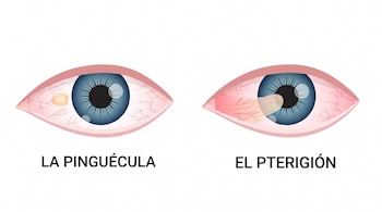 Ilustración de dos ojos; el ojo izquierdo muestra una pinguécula y el ojo derecho un pterigión, ambos con enrojecimiento ocular.