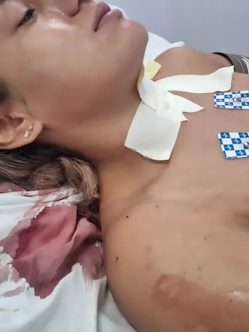 Mujer recostada con el torso desnudo. Cinta médica y parches de monitoreo cardíaco en su cuello y pecho. Se observan algunas manchas en la piel y en la sábana
