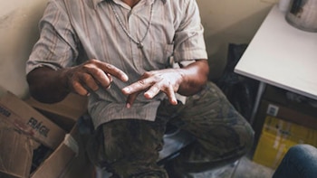 leishmaniasis
