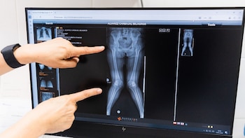 La intervención incluyó el reemplazo simultáneo de la cadera y la rodilla derecha, seguido meses después por la rodilla izquierda - Créditos: Essalud.