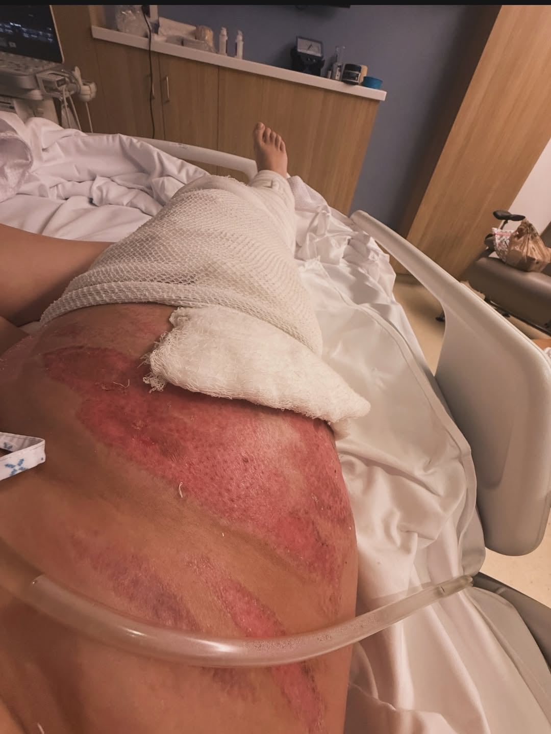La recuperación incluye 17 intervenciones quirúrgicas y múltiples efectos de la anestesia