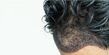 La micropigmantación capilar es un