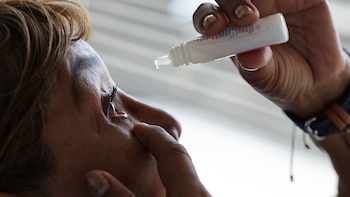 Conjuntivitis y otras infecciones oculares