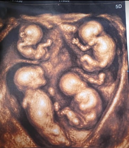 Los cuatrillizos Mariano, Maximiliano, Emiliano y Thiago nacieron tras 34 semanas de gestación en la Clínica del Prado de Medellín - crédito @cuatrillizos Caucasia/TikTok