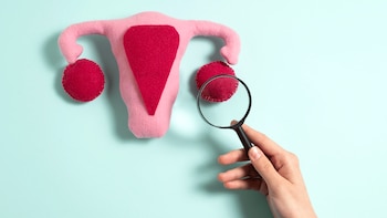 La endometriosis se caracteriza por