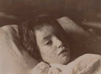 Fotografía sepia de cerca mostrando el rostro de un niño con numerosas pústulas, acostado en una almohada blanca con expresión cansada