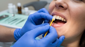 Manos con guantes azules sostienen un aplicador amarillo con una carilla blanca frente a los dientes superiores de una persona.
