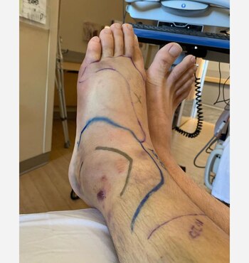 La pierna izquierda de Mike