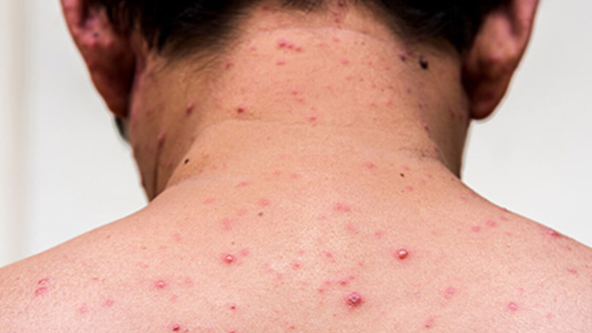 Recientemente, cuatro ciudadanos uruguayos recorrieron varias provincias argentinas, mientras se encontraban enfermos de sarampión (Foto: Ministerio de Salud)