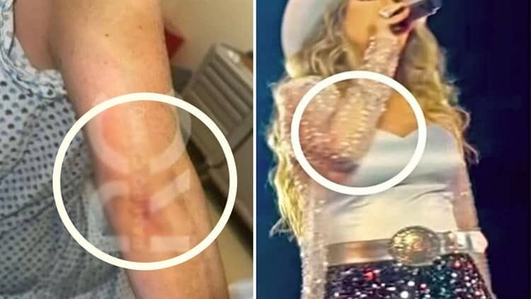 Marcas de Alicia Villarreal, presuntamente resultado de la violencia de Cruz Martínez. (Ramíro Cantú/Captura de pantalla)