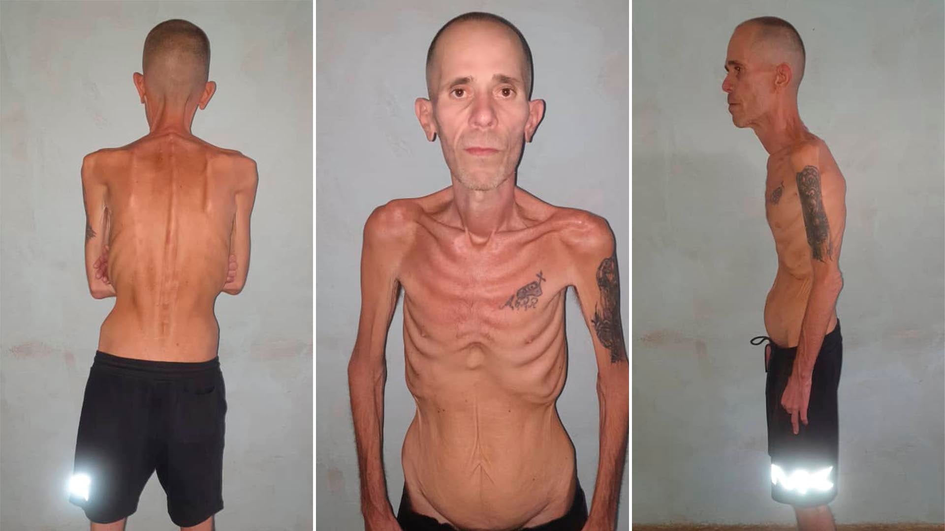 Alexander Díaz Rodríguez, un preso político cubano, aparece en estas desgarradoras imágenes mostrando un estado de extrema delgadez que ha generado preocupación sobre su salud y condiciones carcelarias.