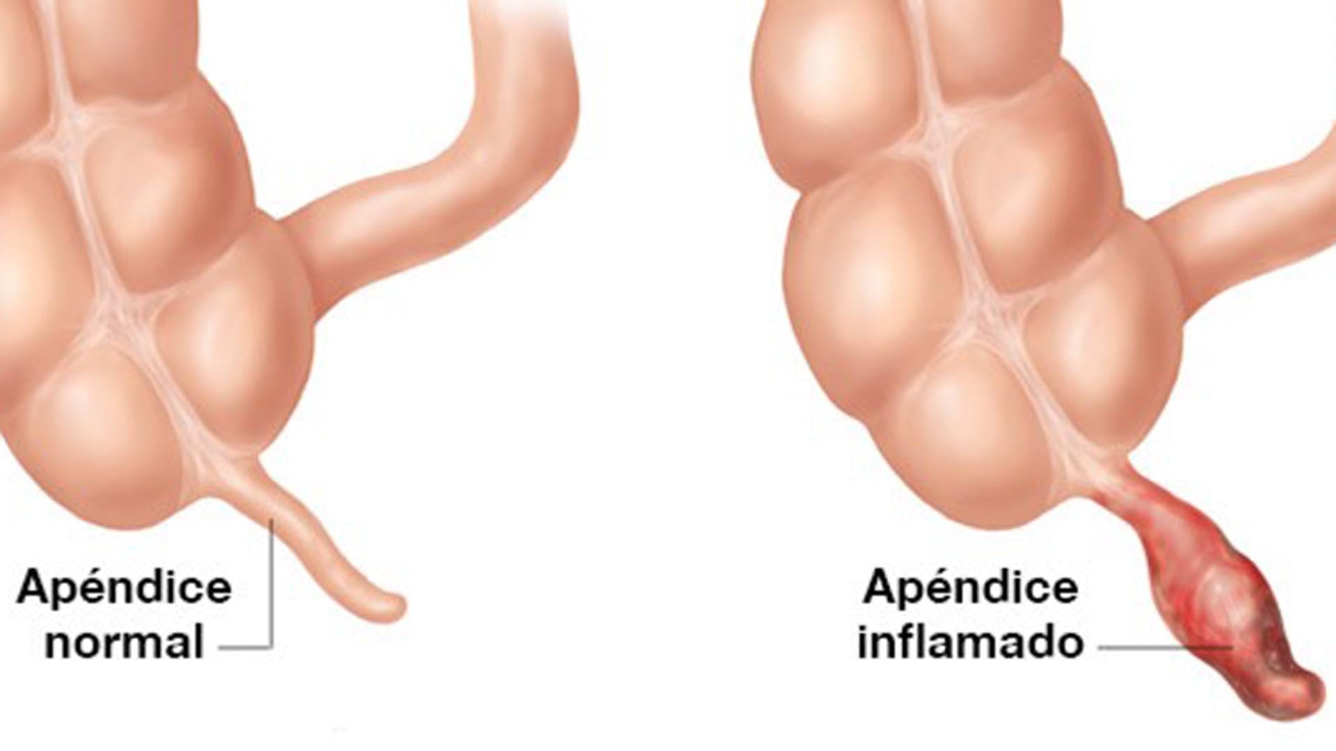El apéndice es una porción del intestino grueso, de forma tubular que mide habitualmente entre 3 y 5 cm de largo y hasta 6 mm de espesor. Se origina del ciego, que es la primera porción del intestino grueso