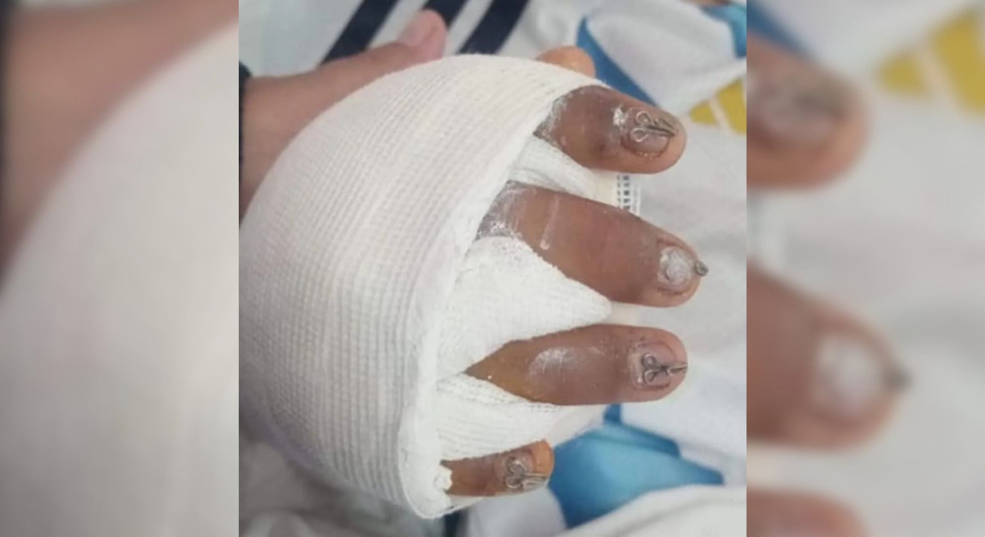 Así quedó la mano del alumno accidentado (Gentileza: Jujuy al Momento)
