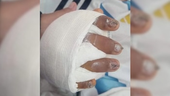 “Tiene el 95% de la mano destruida”: la mamá de un alumno accidentado en una escuela de Jujuy denunció abandono