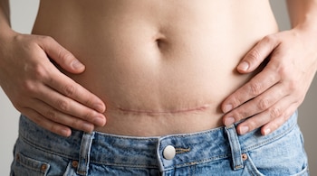 Abdomen de una mujer con ombligo y una cicatriz horizontal de cesárea. Dos manos se apoyan en los costados y viste jeans azules.
