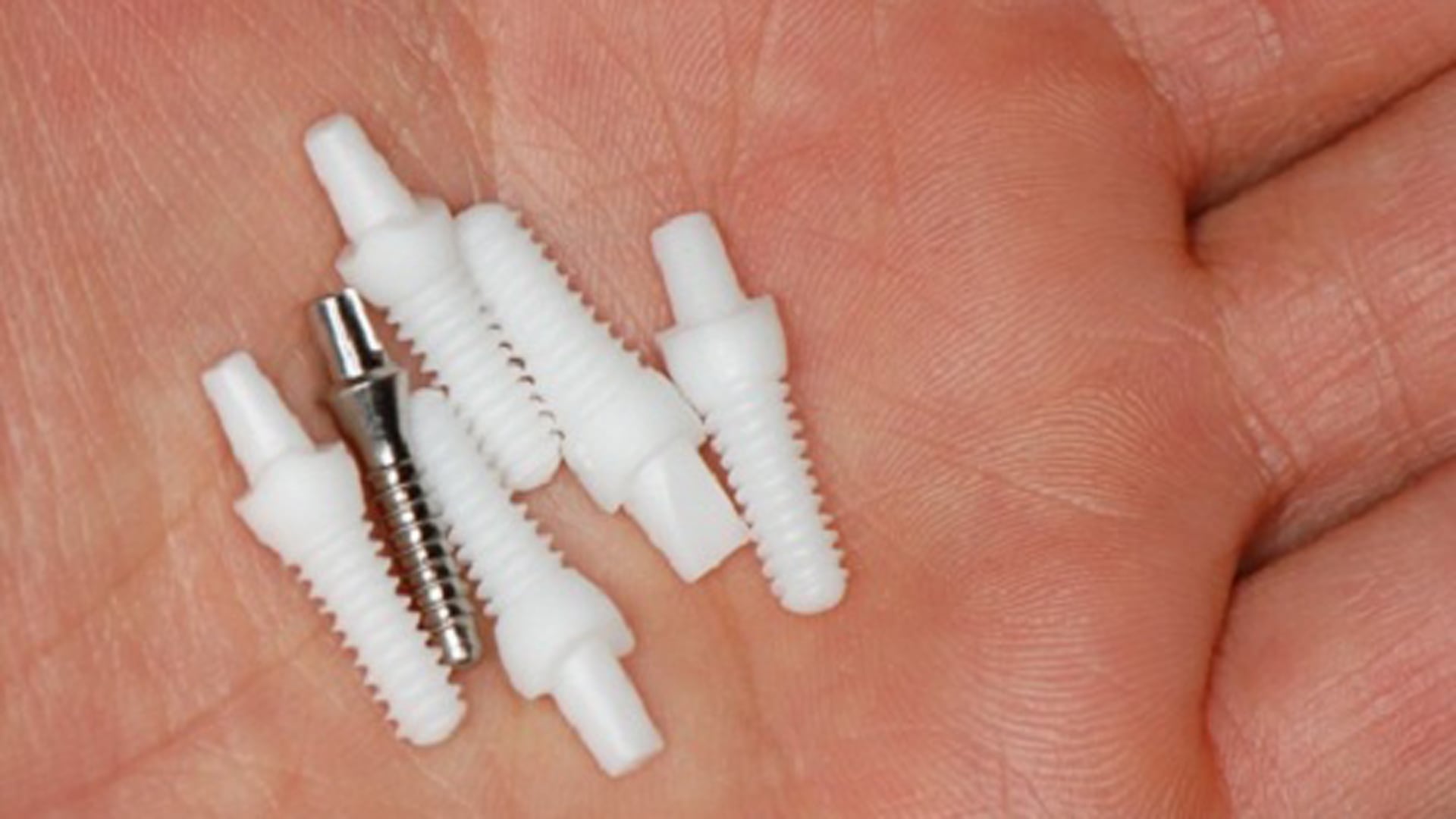 Las prótesis provisorias no se adaptaron correctamente y provocaron molestias, dificultades para alimentarse y cambios en la apariencia facial de la paciente. (Foto de archivo)