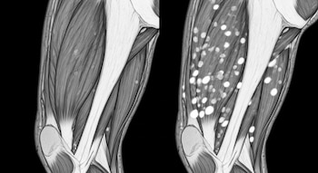 Dos imágenes médicas monocromáticas de resonancia magnética de muslos. La izquierda muestra músculo uniforme; la derecha, numerosos puntos brillantes de infiltración de grasa.