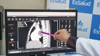 El caso involucró la colaboración de profesionales en cirugía pediátrica, neumología, cardiología, cuidados intensivos y nutrición, quienes planificaron meticulosamente la intervención - Créditos: Essalud.