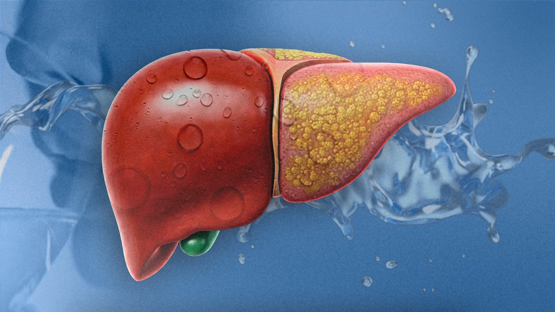 ¿Qué es el hígado graso y por qué representa un riesgo?
(Foto: Infobae México/ Jovani Pérez)