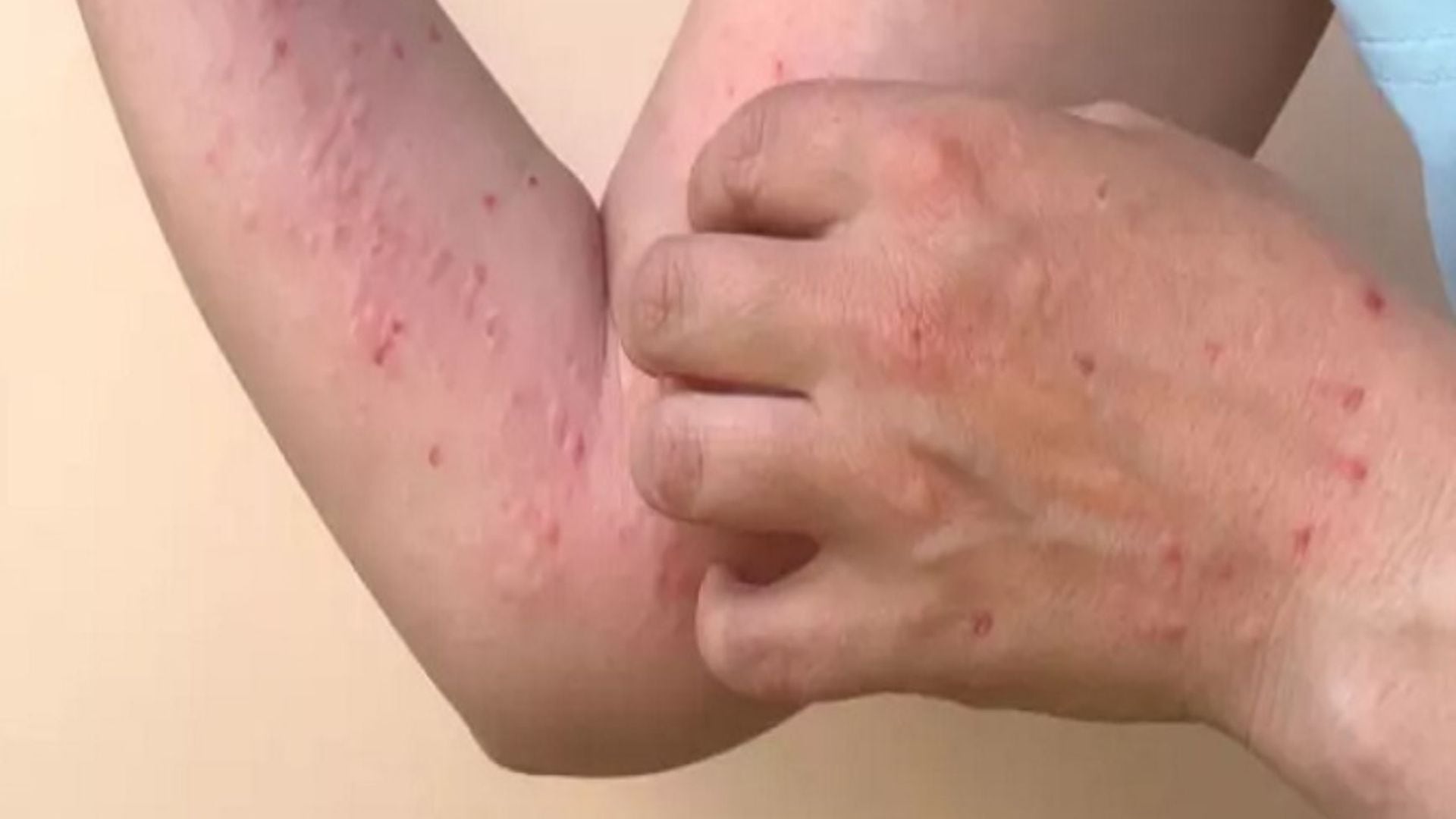 Fiebre, dolores musculares, fatiga, dolor de cabeza e inflamación de ganglios linfáticos se presentan entre los síntomas frecuentes de la Mpox. (Freepik)